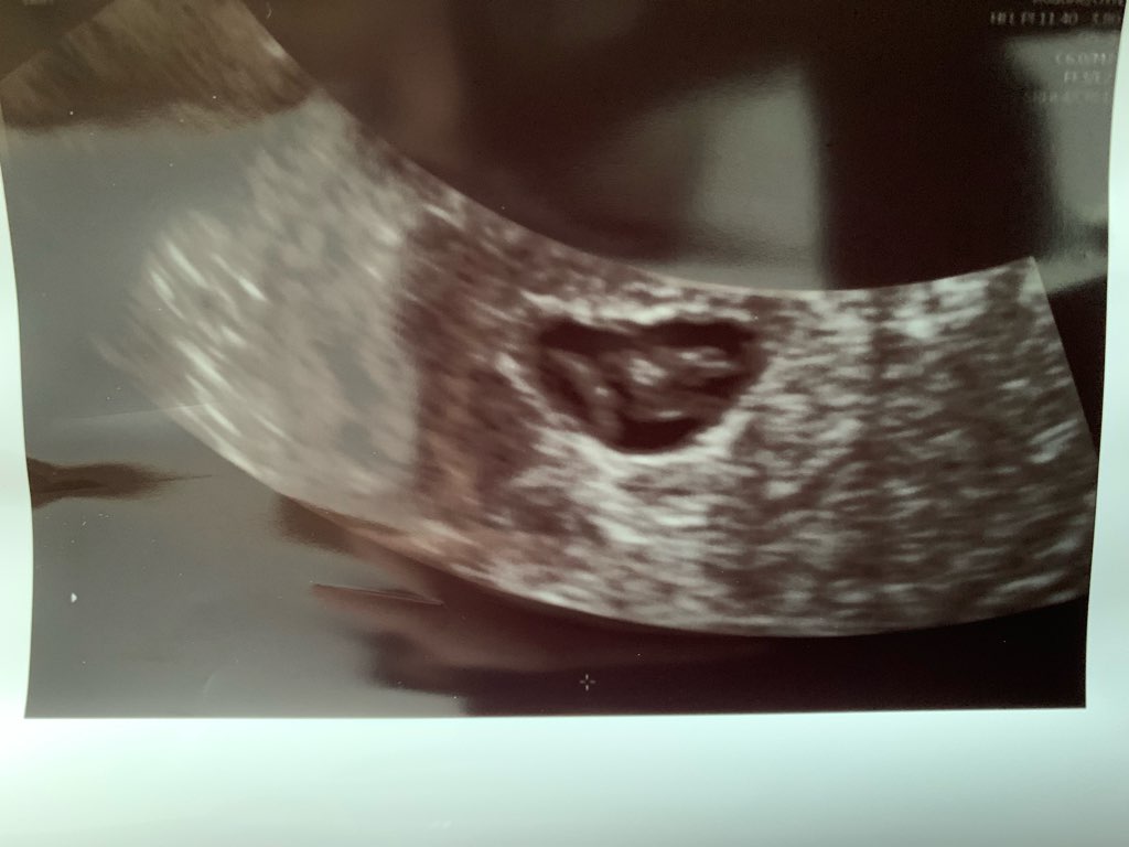 体外受精　顕微授精　妊娠初期　大量出血　無事　心拍確認　7w 胎嚢　小さめ